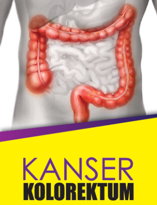 Kanser Kolorektum